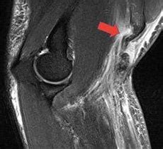 Distal Biceps Tendon Rupture Repair and Reconstruction