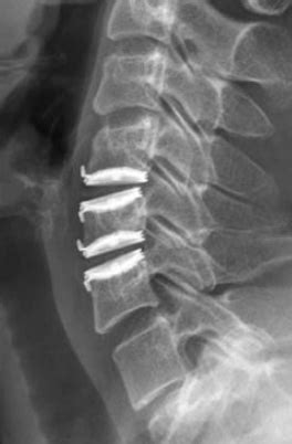 Cervical Disc Arthroplasty - Spine - Orthobullets