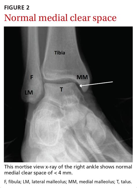 High ankle sprains: Easy to miss, so follow these tips | MDedge Family Medicine