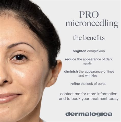 MicroNeedling - Beauty by Katrina