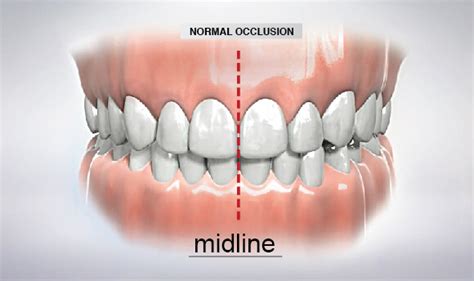 Normal Dental Occlusion Midline - Westcoast International Dental Clinic