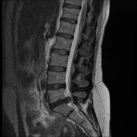 Disc extrusion - L5/S1 | Image | Radiopaedia.org