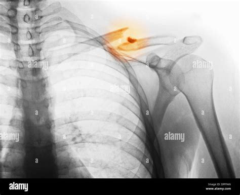 x-ray showing fractured clavicle Stock Photo - Alamy