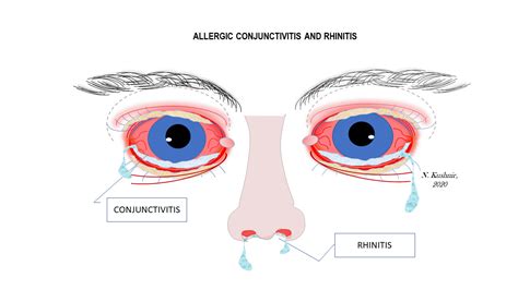 Allergic Pink Eye - Allergy & Immunology Doctor