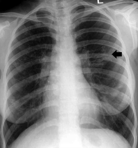 Bronchiectasis Chest X Ray