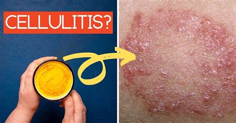 Treating Cellulitis at Home - 7 Home Remedies for Cellulitis