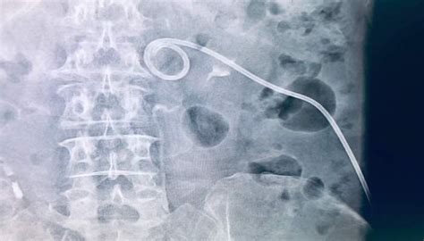 PCNL Nephrostomy Tube Placement For Kidney Stones | BackTable Urology