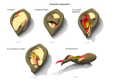 MAYA Workshop "Digital Surgery" : Broström Procedure – IAAC Blog