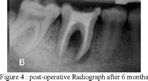 Figure 4 from Pulp Orperiodontium??-Diagnosis and Management of Endo - Perio Lesion. | Semantic ...