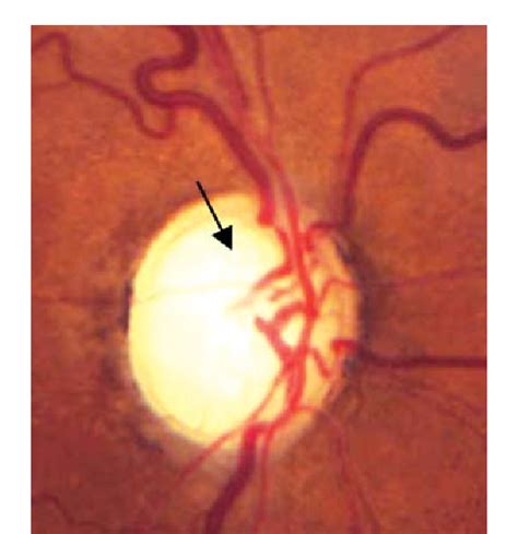 Figure 1 from Clinical Evaluation of Optic Nerve Head in Glaucoma | Semantic Scholar