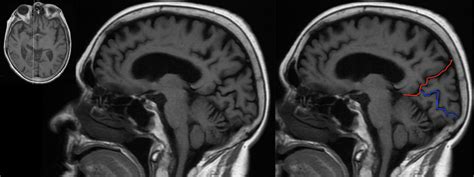 Radiological Anatomy: Calcarine Sulcus - Stepwards