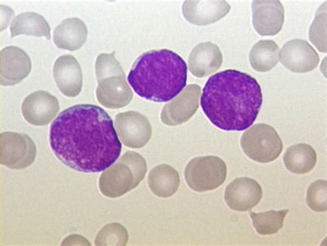 leukemia low grade fever 13 causes of low grade temperature » pharmacy-peoples.com best medical