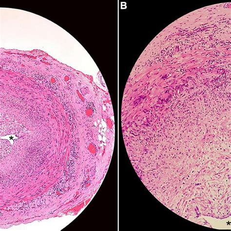 Histopathology of superficial temporal artery biopsy showing (A ...