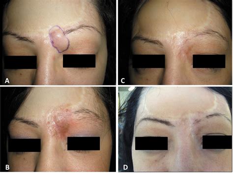 Electrochemotherapy of a Multirecurrent Dermatofibrosarcoma Protuberans of the Orbital Margin: A ...