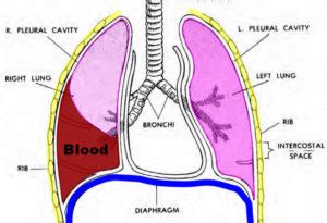 Hemothorax causes, signs, symptoms, diagnosis & hemothorax treatment