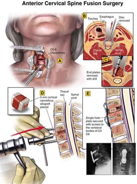 acdf surgery - Google Search | Acdf surgery, Neck surgery, Spinal surgery