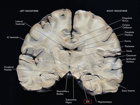 Frontiers | Anatomy and Connectivity of the Subthalamic Nucleus in ...