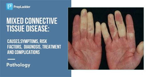 Mixed Connective Tissue Disease: Causes, Symptoms, Risk Factors, Diagnosis, Treatment and ...