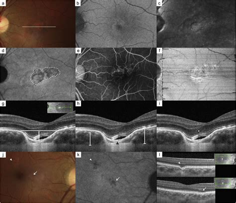 FCE complicated with chronic CSCR in the left eye and idiopathic FCE in... | Download Scientific ...