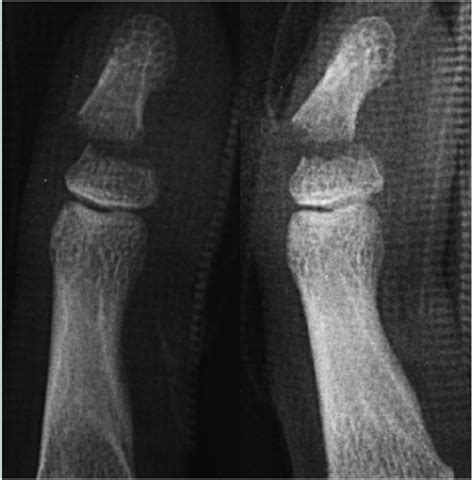 Typical radiographs of a Seymour-like fracture, demonstrating ...