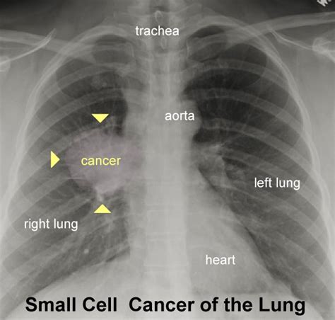 Chest Xray Cancer