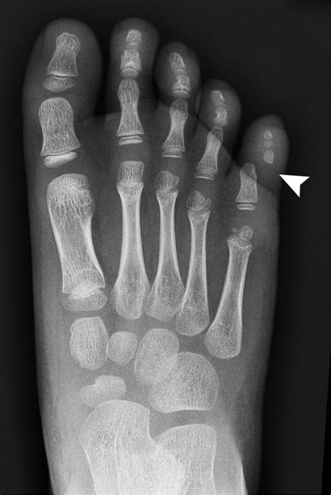 Post-traumatic toe deformity in a child | The BMJ