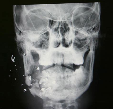 Facial Trauma Surgery San Francisco | Alex Rabinovich MD, DDS