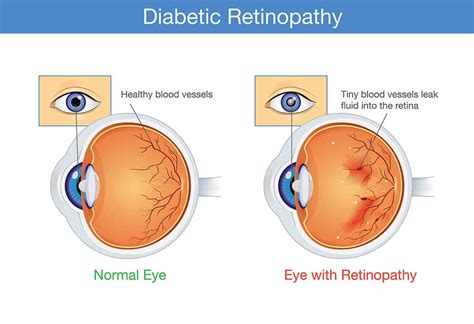 Diabetic Retinopathy: Causes & Treatments | Chelvin Sng Eye Center | Glaucoma | Cataract ...