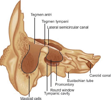 Tegmen Tympani Dehiscence