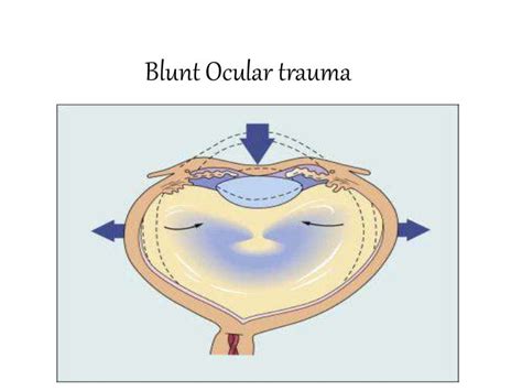 Blunt Ocular trauma