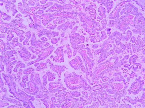 Papillary carcinoma – Thyroid – Histopathology.guru