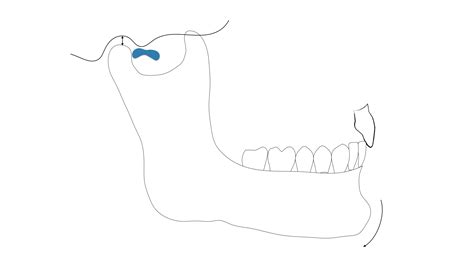 A Guide to Assessing and Treating the Anterior Open Bite