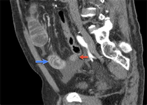 The Radiology Assistant : Closed Loop Obstruction in Small bowel ...