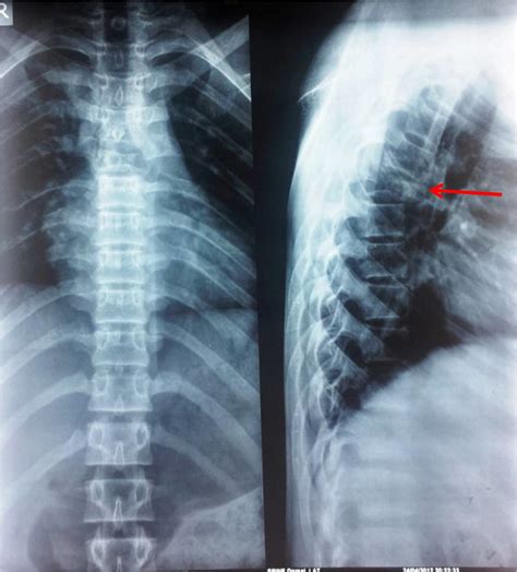 Cureus | Solid Variant of an Aneurysmal Bone Cyst of the Thoracic Spine