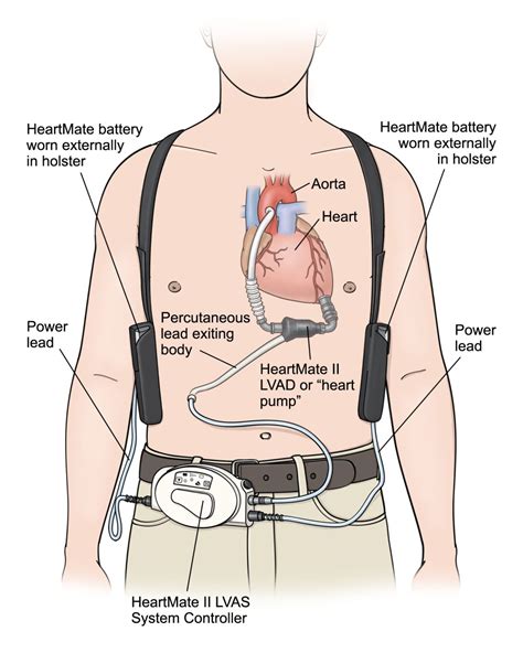 Ventricular Assist Devices: Expanding Role for Long Term Cardiac Support | IntechOpen