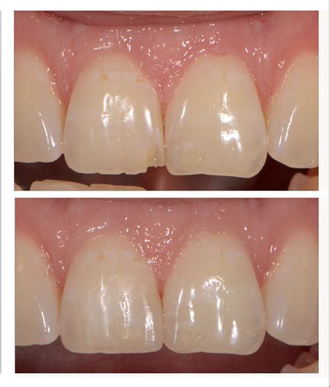 How to Layer Composites in the Esthetic Zone - Spear Education