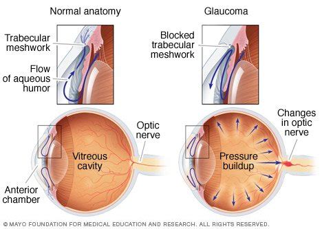 Glaucoma Disease Reference Guide - Drugs.com