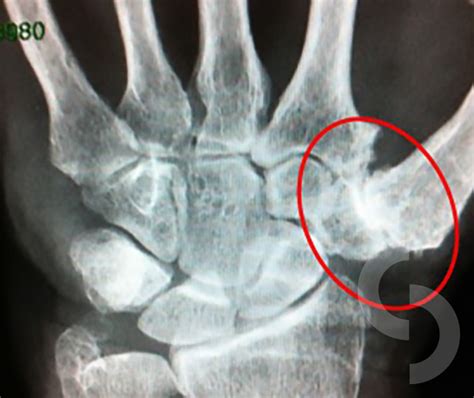 Thumb Basal Joint Arthritis | dr Sonja Cerovac