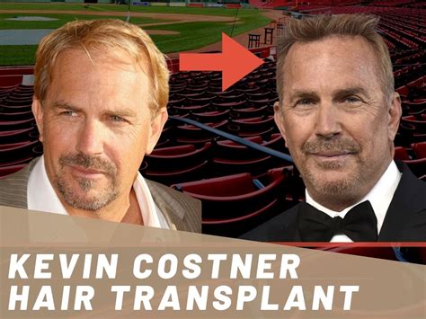 Kevin Costner Hair Transplant - Hair Loss & Technical Analysis