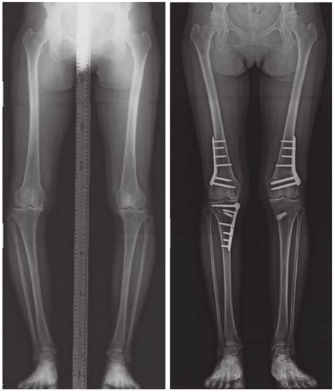 Osteotomy around the knee. Depending on the locations of varus and ...