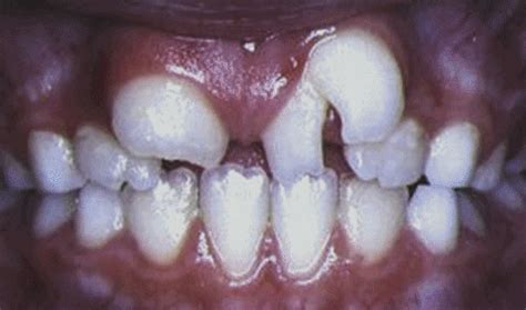 How To Treat: Fusion of Maxillary Anterior Teeth// Macrodontia – PART III – Morning Huddle