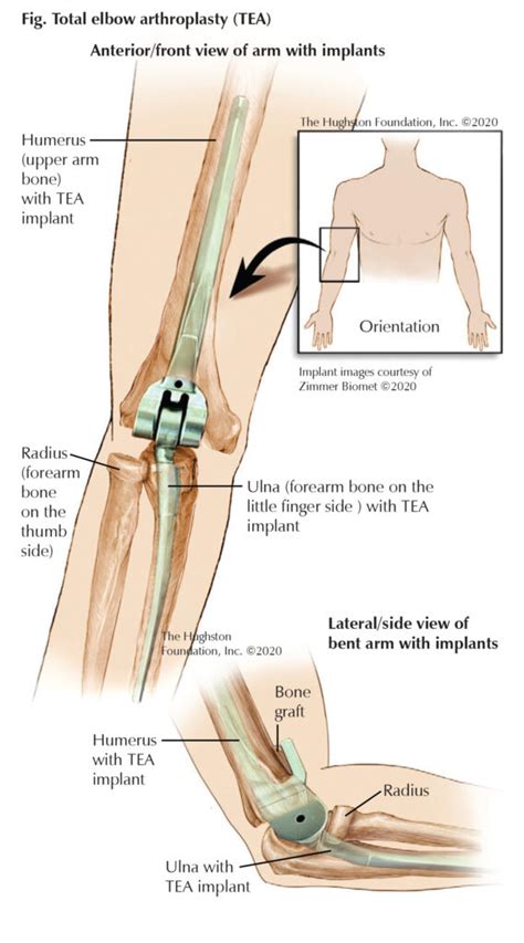 Total Elbow Arthroplasty: Questions for a Specialist - Hughston Clinic