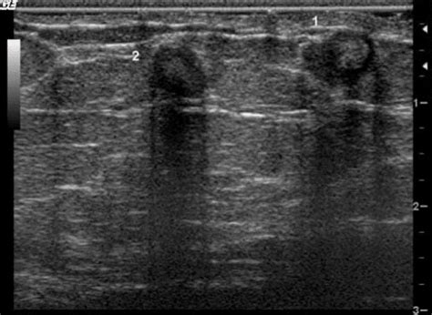 Fat Necrosis Breast Ultrasound