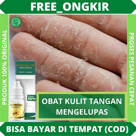 Obat telapak tangan mengelupas, Kulit tangan megar, Kulit tangan kering, Alergi detergen, Kulit ...