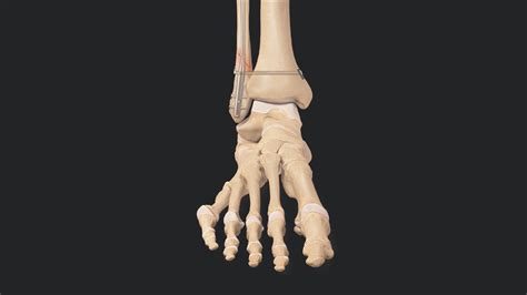 Arthrex - Ankle Fracture Revision Using a FibuLock® Nail and TightRope® XP Implants