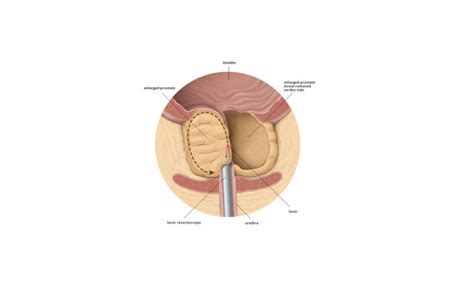 Laser Prostatectomy - Prostate Laser Surgery - Ashvin Clinic | Dr. K. Ramesh | Centre for ...