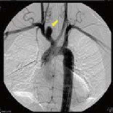 ( A ) “Normal aortic arch” anatomy, ( B ) “Bovine aortic arch,” ( C )... | Download Scientific ...