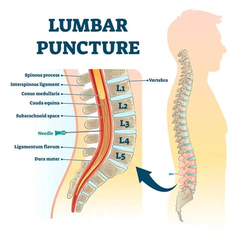 Lumbar puncture vector illustration. Labeled spine structure procedure scheme