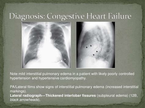 Chf exacerbation