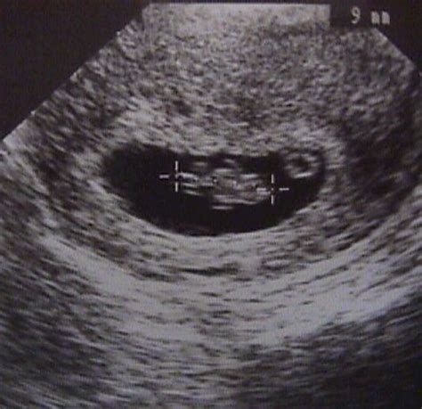 1st Trimester Ultrasound Scanning